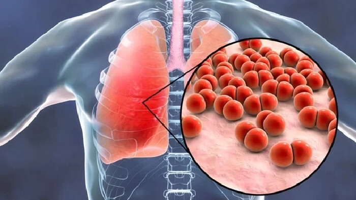 Pneumónie a pneumokoky